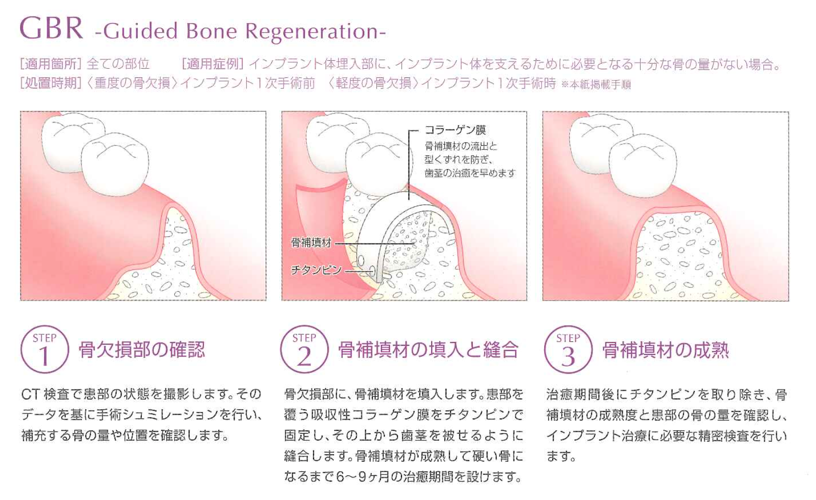 骨や歯茎が不足している部分へのインプラント治療例（GBRとFGGの