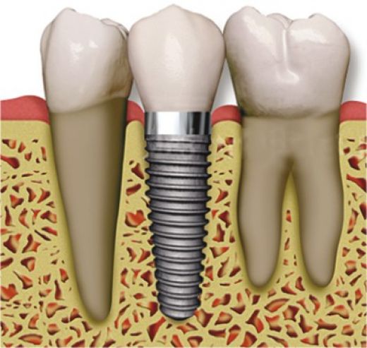 IMPLANT-1