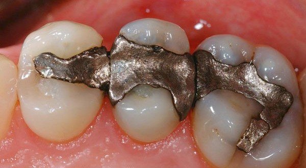 amalgam-fillings-600x330-2