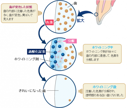 ホワイトニングのメカニズム〜何故白くなるの？〜 - 新浦安の歯医者・歯科｜栗林歯科医院｜各専門医在籍