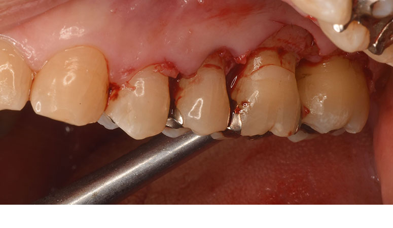 歯周病での抜歯を回避できる！歯を残すための外科治療 - 新浦安の 