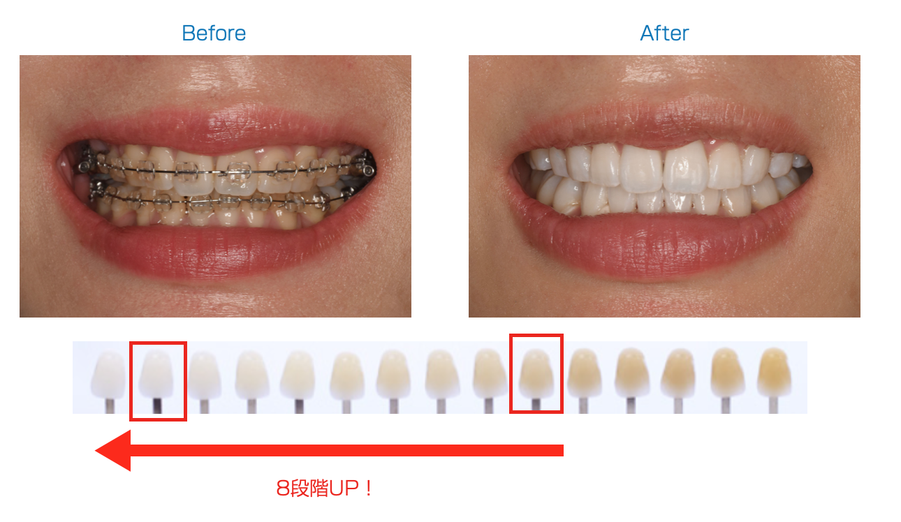 ホワイトニング 一 回 で 白く なる