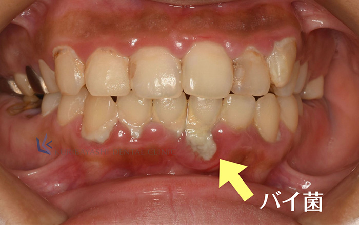 歯 が 抜ける 前兆