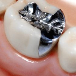 Q.保険診療で奥歯の詰め物を銀歯以外にできる？ | 新浦安の歯医者