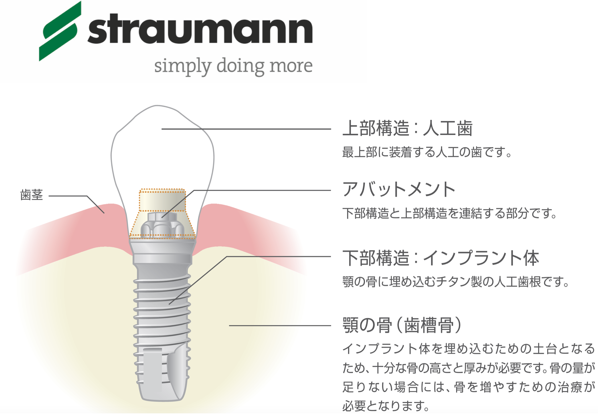 インプラント ≪ストローマン≫
