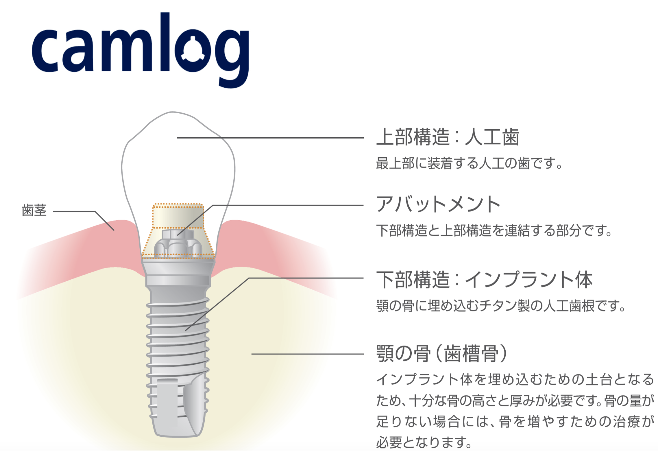 インプラント ≪カムログ≫